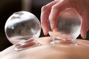 Example of cupping treatment